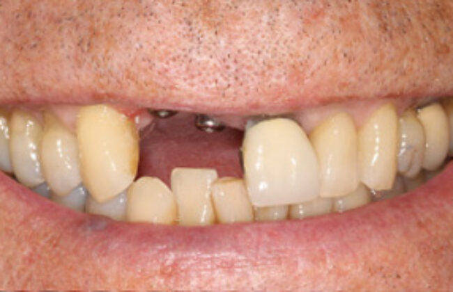 Before