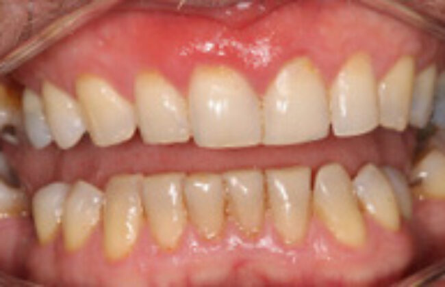 Before