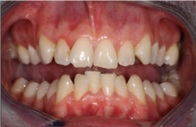Before (Teeth)
