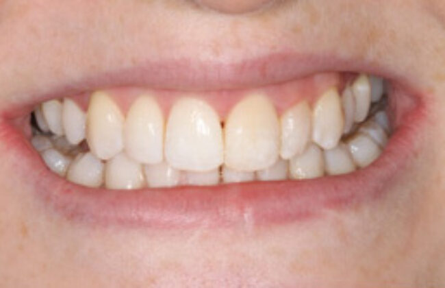After (Teeth)