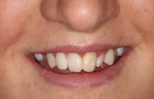 Before (Teeth)