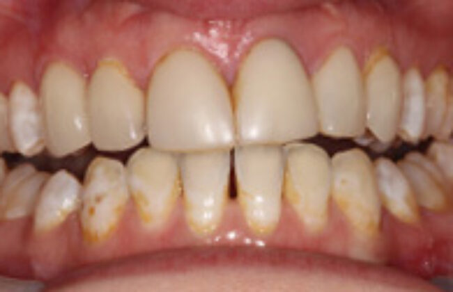 Before