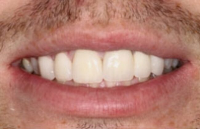After