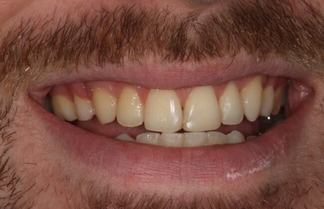 After