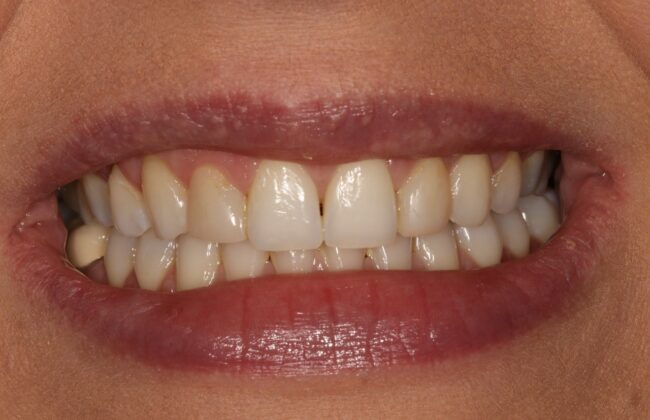 After