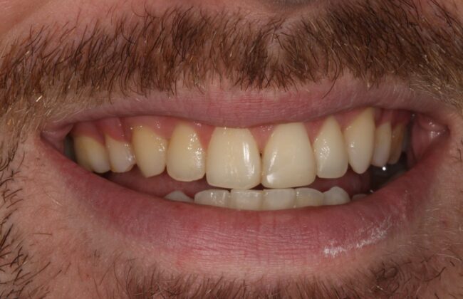 After