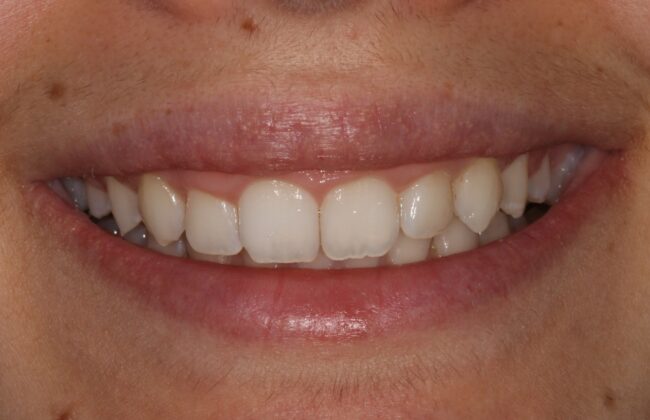 After (Teeth)