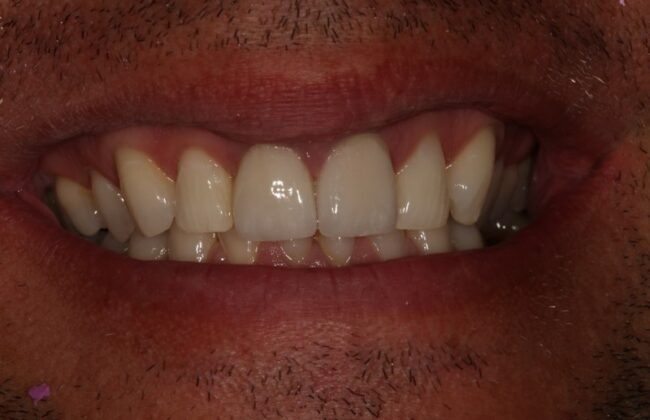 After