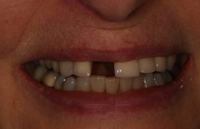 Before
