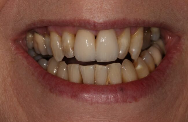 Before (Teeth)