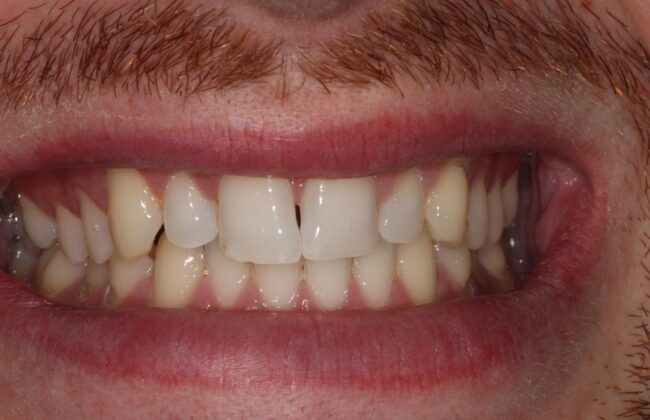 Before