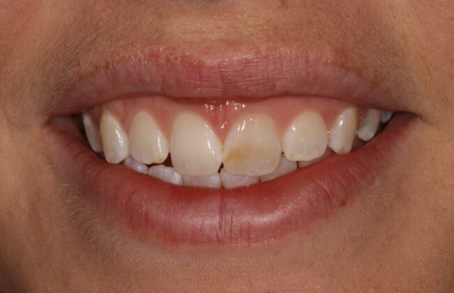 Before
