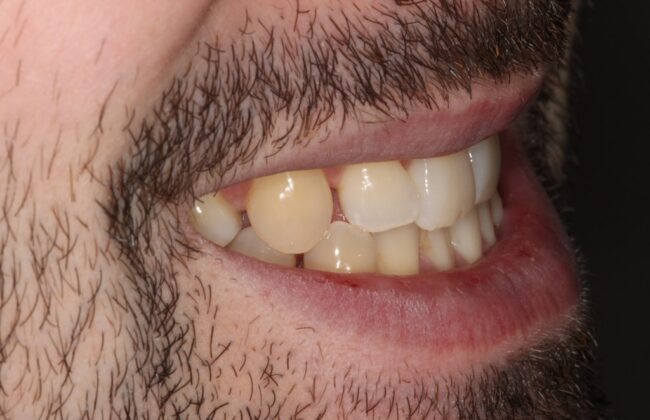 Before