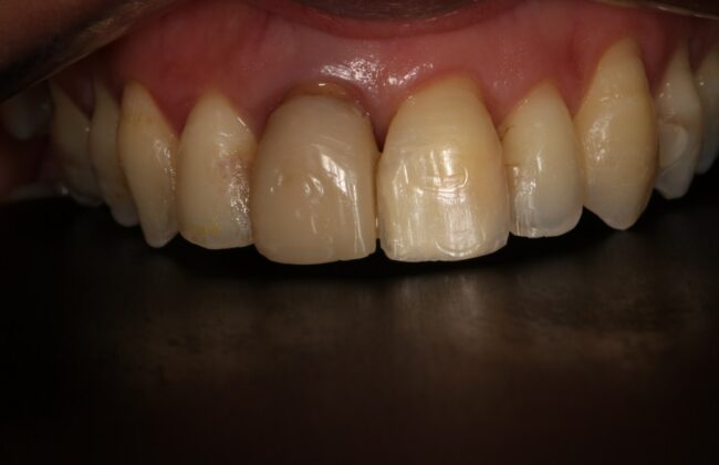 Before