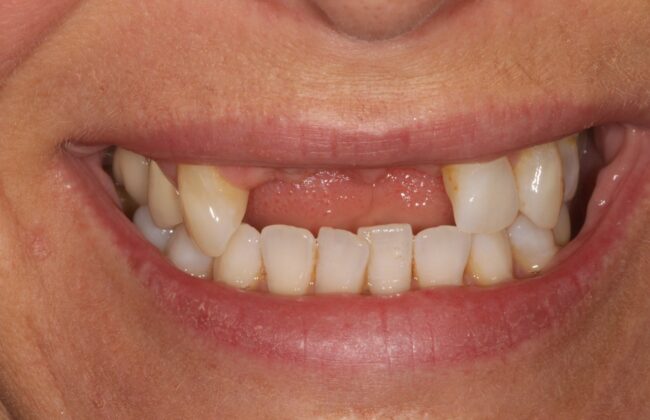 Before