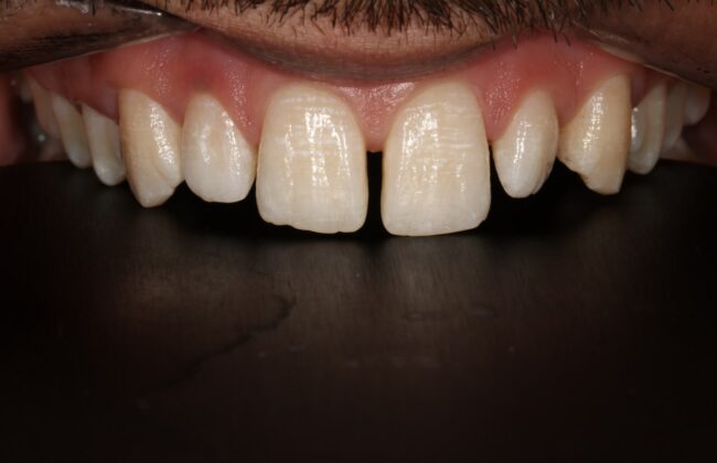 Before