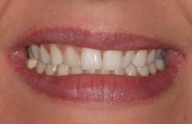 Before