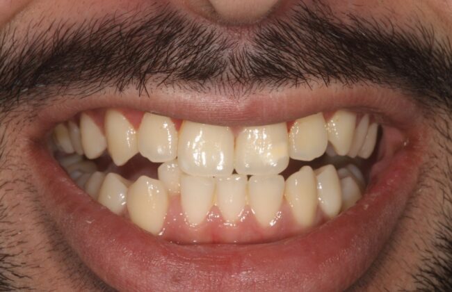 Before