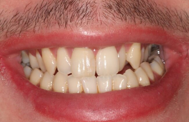 Before