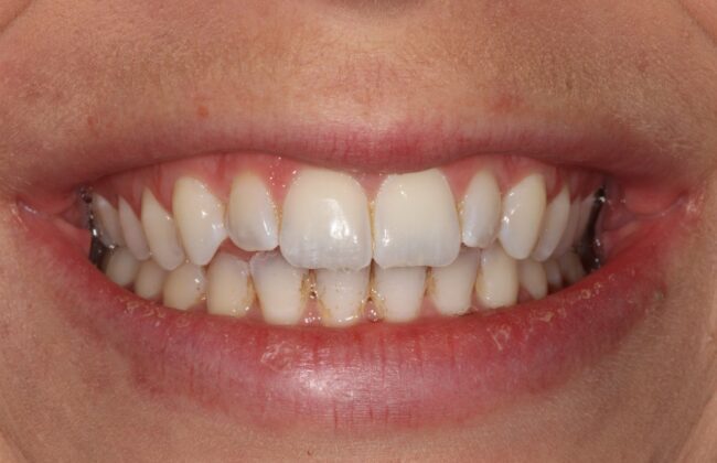Before