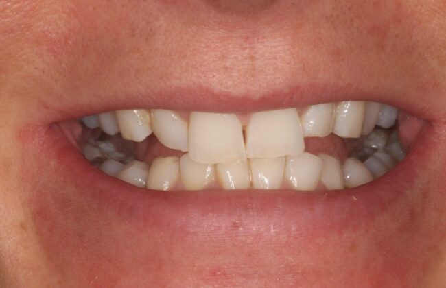 Before