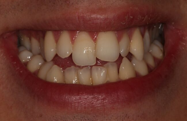 Before