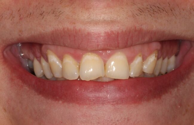 Before
