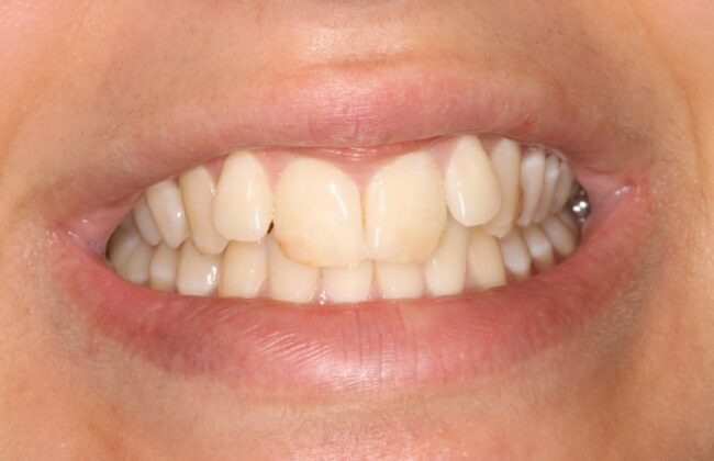 Before