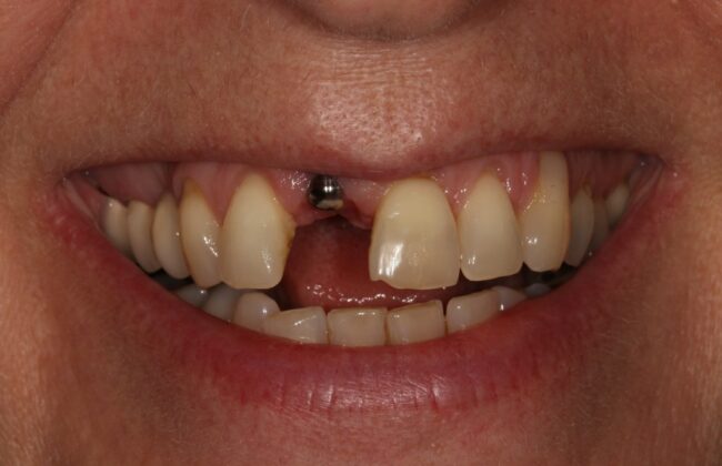 Before