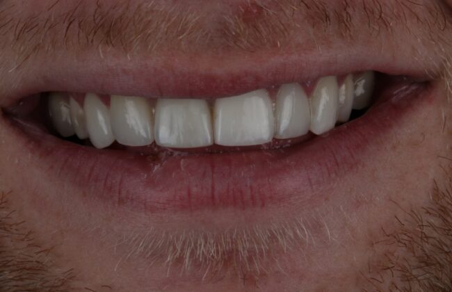 After