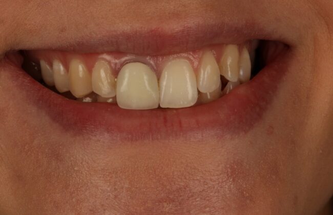 Before