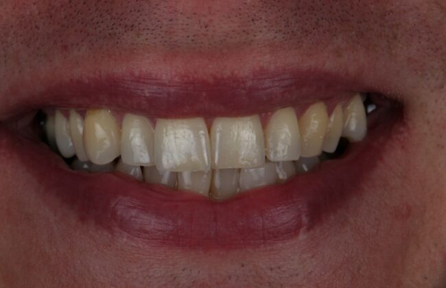 Before