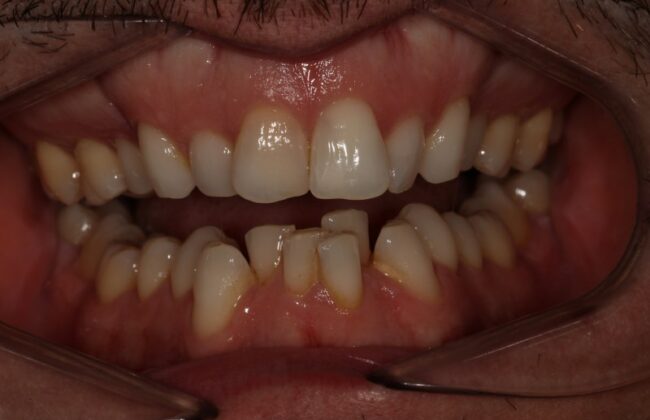 Before