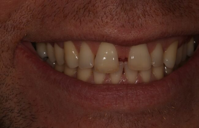 Before