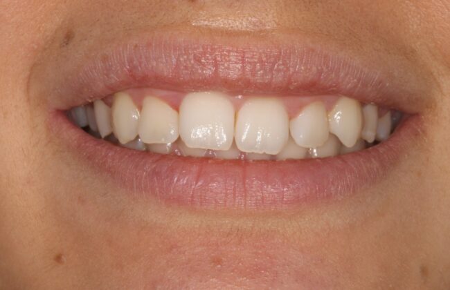Before (Teeth)