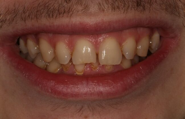 Before