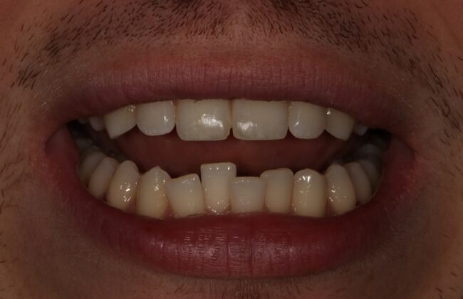 Before