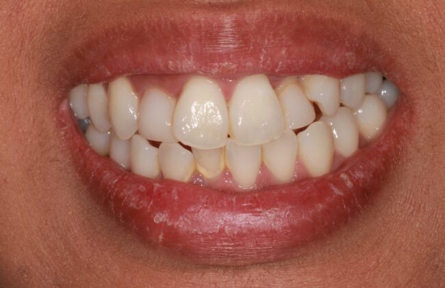 Before