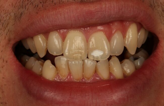 Before