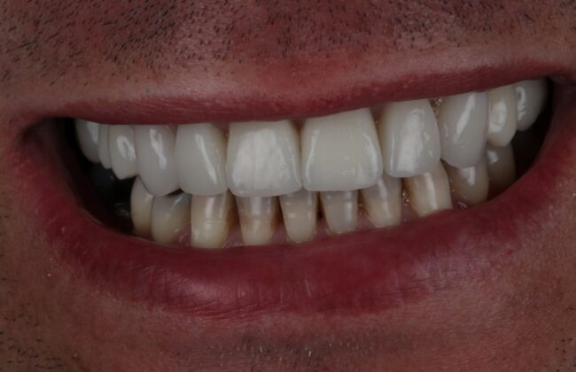 After