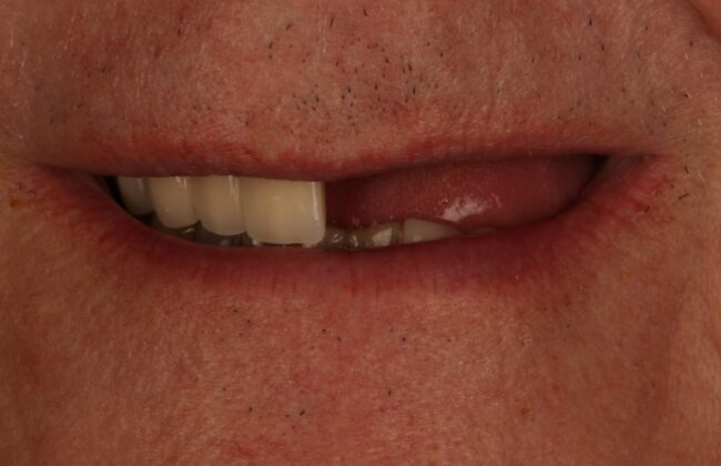 Before