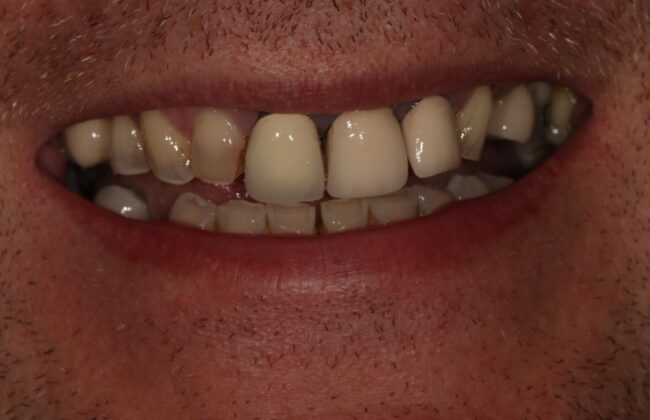 Before