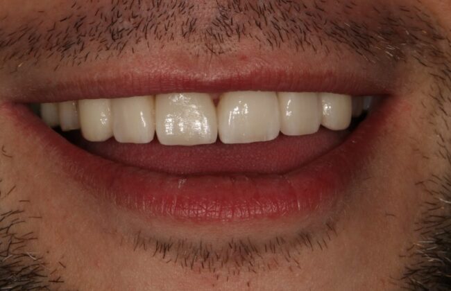 After
