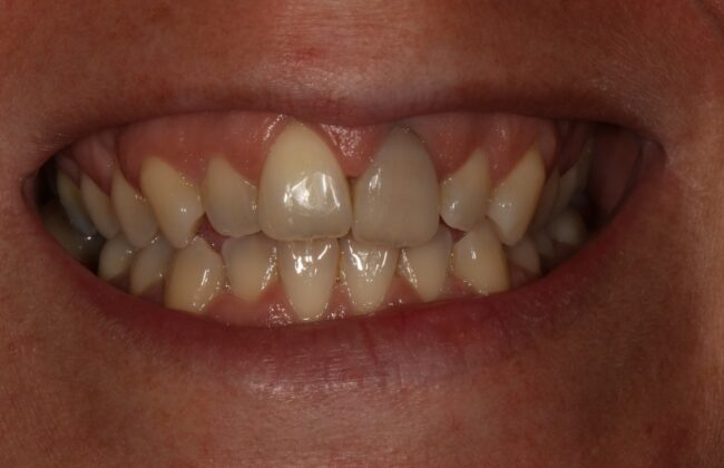 Before