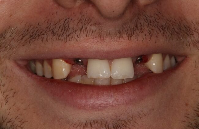 Before