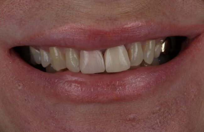 Before