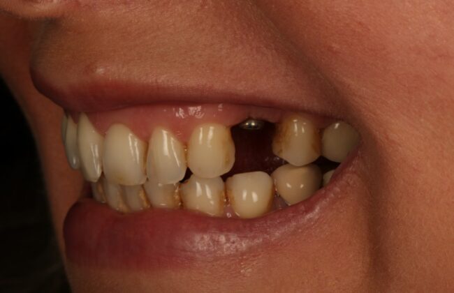 Before