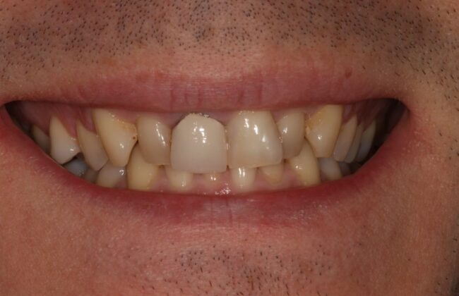 Before