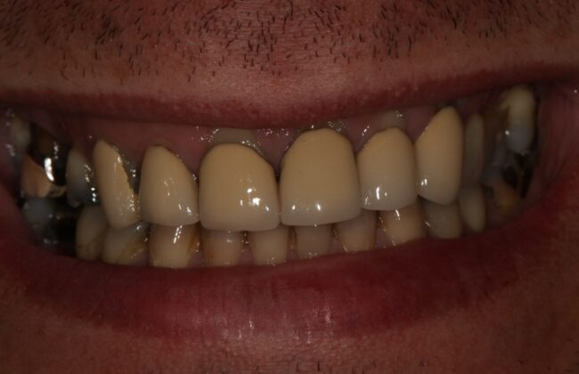 Before