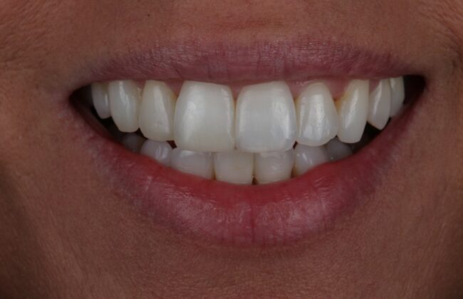 After (Teeth)